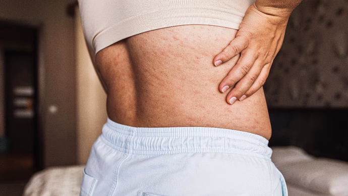 How poor air quality doubles the risk of severe skin disease 1 full bodied woman in beige bra and light pants standing in bedroom demonstrating back and sides cov 252236972