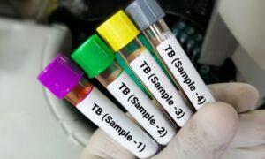 TB Testing