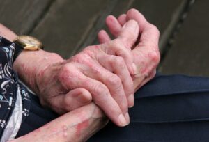 eczema.hands .red .itchy copy