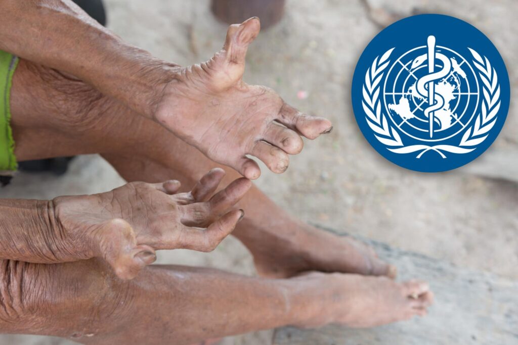 WHO Appeals for Global Unity in the Fight Against Leprosy. 1 WhatsApp Image 2025 01 29 at 3.43.39 PM
