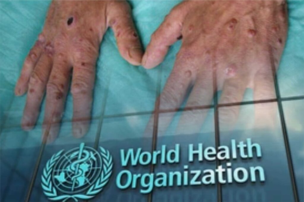WHO Launches New Course to Enhance Management of Cryptococcal Disease in HIV Patients. 1 WhatsApp Image 2025 02 05 at 1.25.55 PM