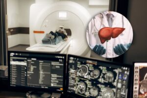 liver cancer