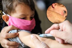 MEASLES 1