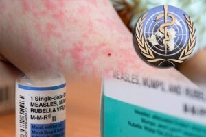 MEASLES 2