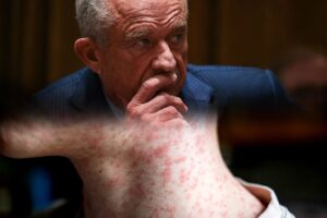 MEASLES