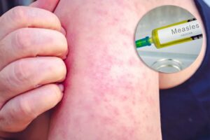 measles 3