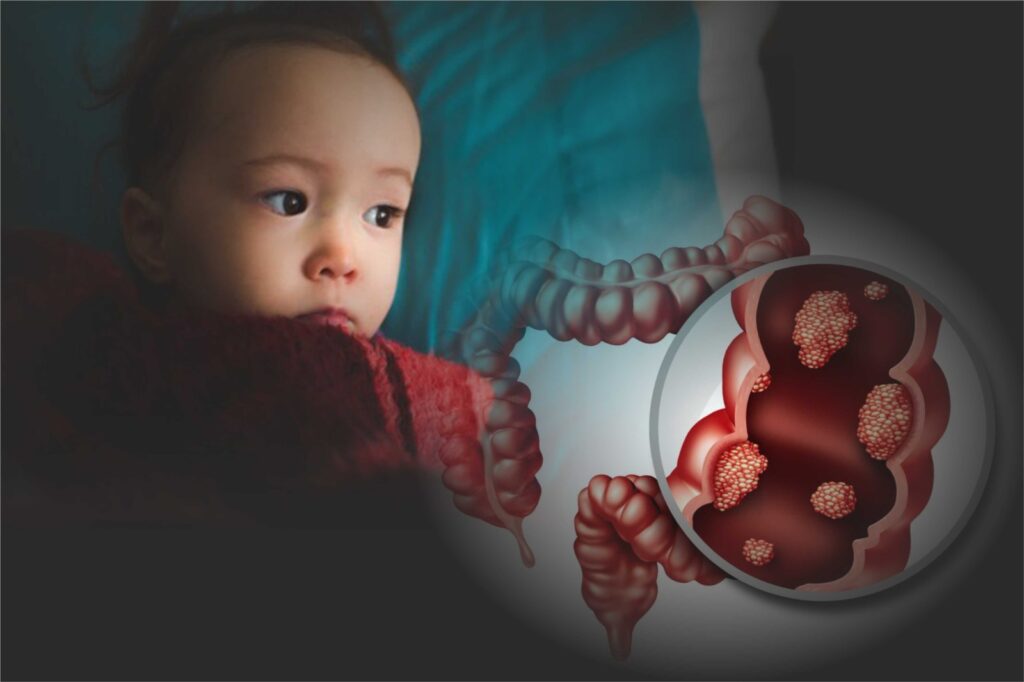 Childhood gut toxin may fuel colon cancer surge in the young 1 Childhood gut toxin may fuel colon cancer surge in the young