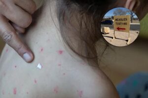 Measles Testing Texas