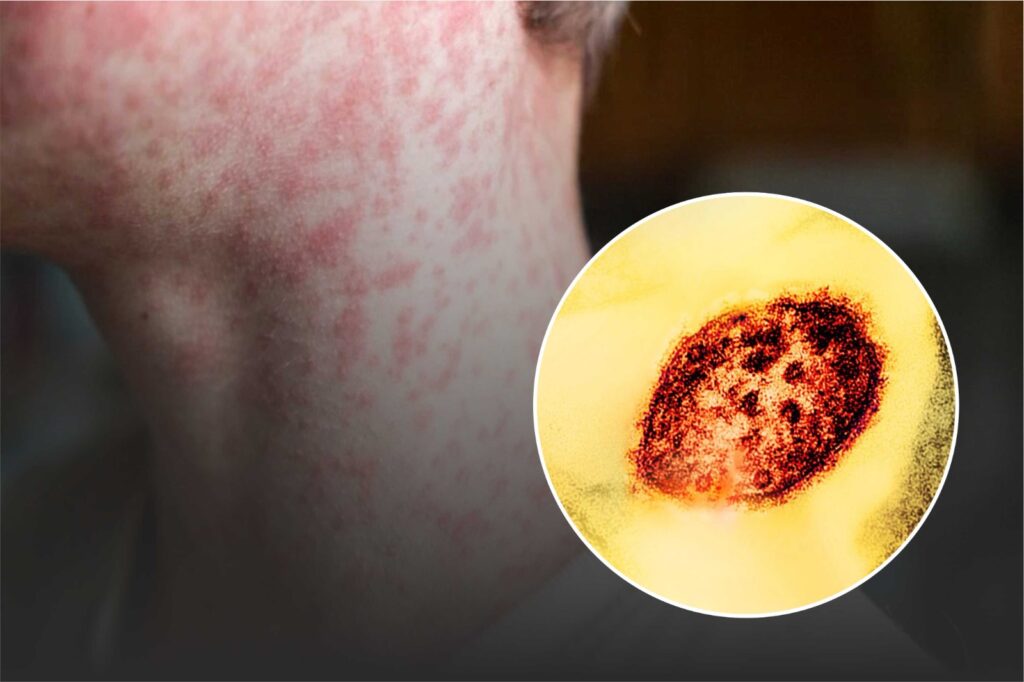 Measles could become endemic in US, warn experts 1 Measles could become endemic in US, warn experts
