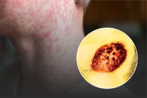 Measles could become endemic in US, warn experts