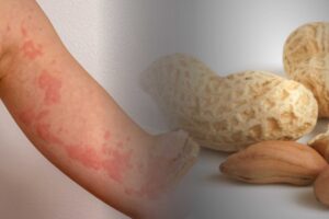 New trial suggests daily peanut exposure can lower allergy risk in adults
