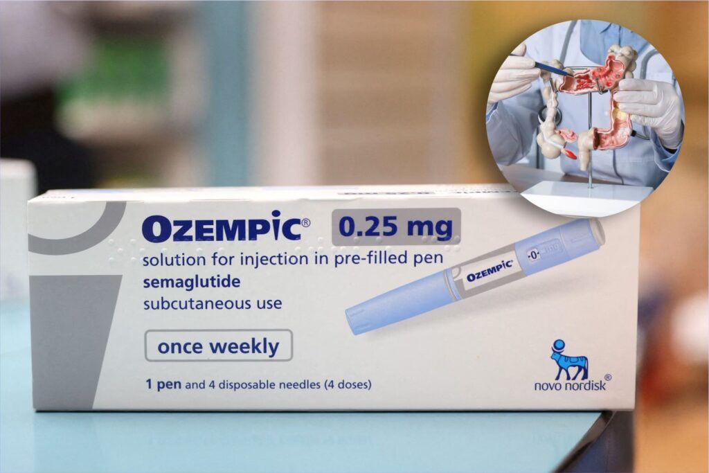 Study links GLP-1 diabetes drugs to reduced colorectal cancer risk