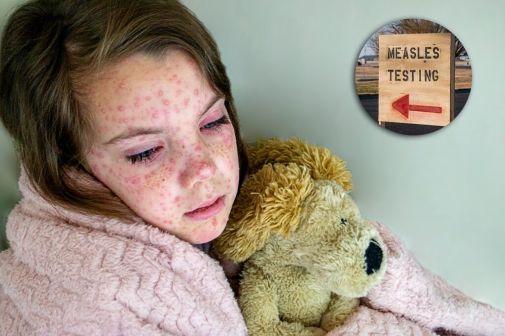 US measles cases top 1,000 for first time in 5 years 1 US measles cases top 1,000 for first time in 5 years