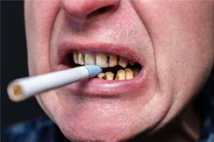 Smoking damage can be spotted in teeth long after you quit: Study