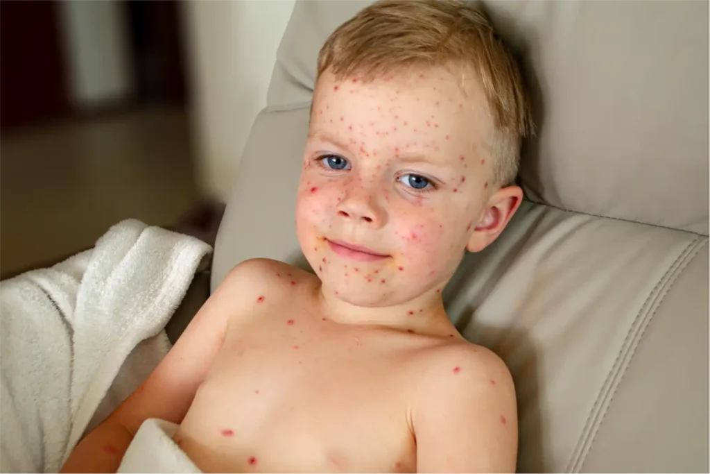Measles reaches 25-year high in the US amid vaccine decline 1 Measles reaches 25-year high in the US amid vaccine decline
