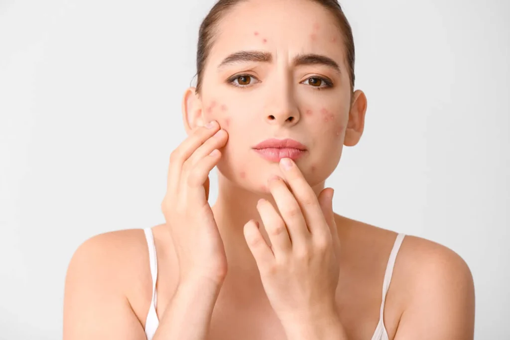 Acne myths vs. facts: What actually works for clear skin?