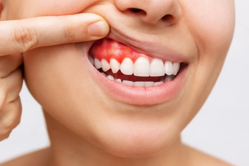Bleeding gums? Bad breath? It might be pyorrhoea. Here’s what you need to know 1 Bleeding gums? Bad breath? It might be pyorrhoea. Here’s what you need to know
