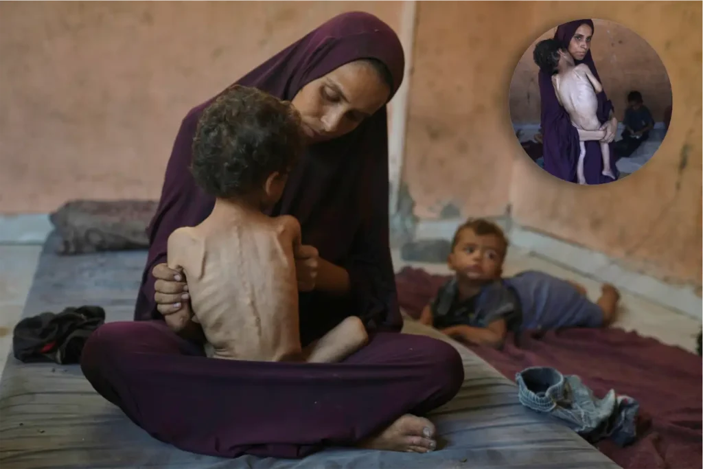Gaza malnutrition deaths climb to 74 in 2025; 63 in July alone 1 Gaza malnutrition deaths climb to 74 in 2025; 63 in July alone