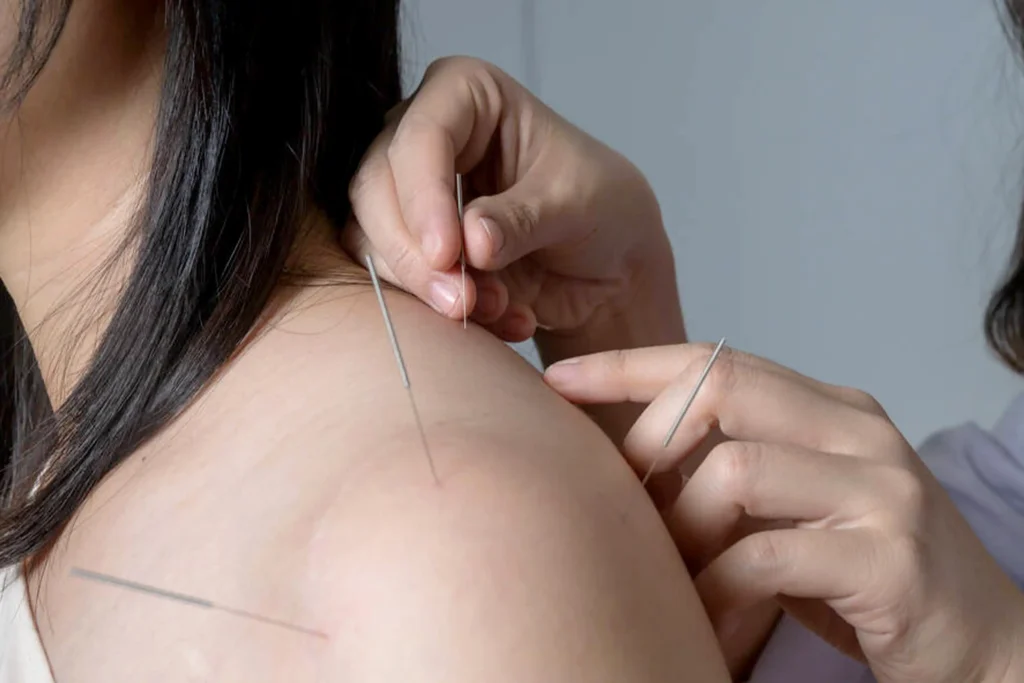 How acupuncture works: The health benefits from tiny needles