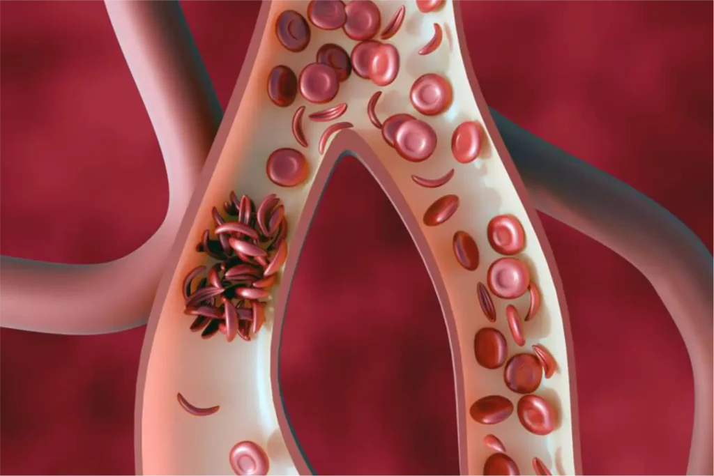 Six crore people screened for sickle cell disease: Health Ministry 1 Six crore people screened for sickle cell disease: Health Ministry