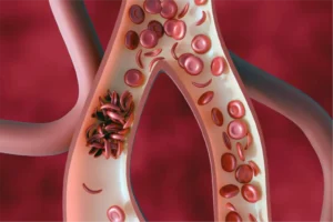 Six crore people screened for sickle cell disease: Health Ministry