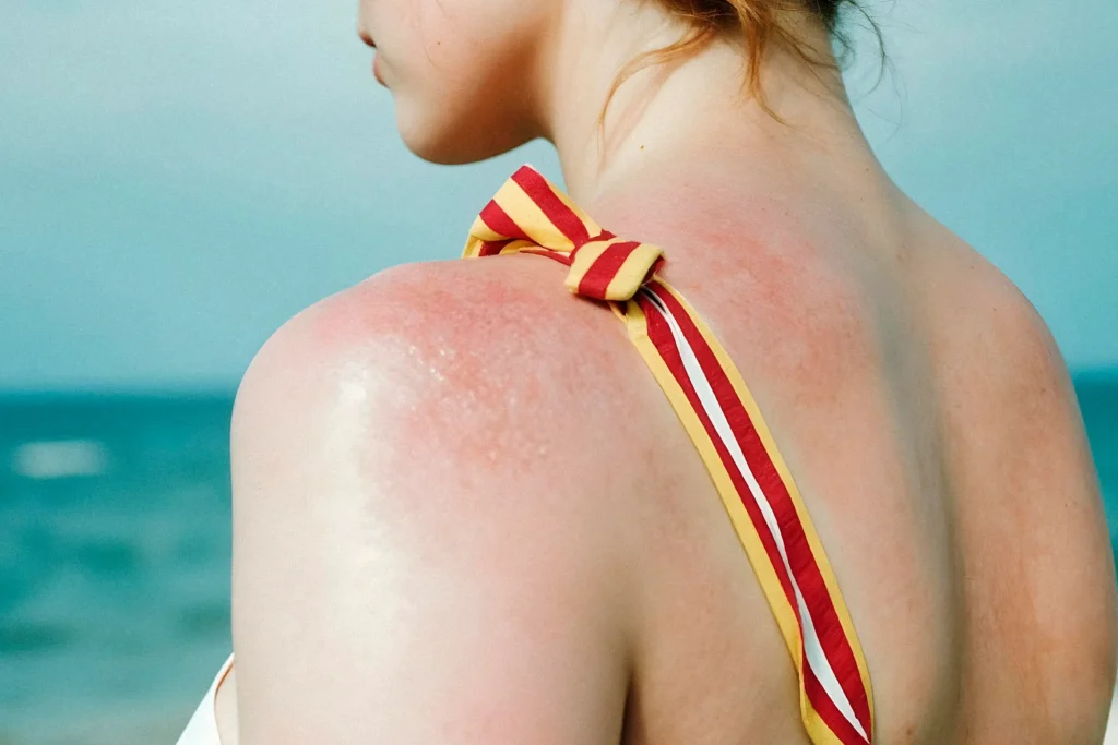 Summer skincare guide: Treating sunburn, sweat rashes & more 2 Summer skincare guide: Treating sunburn, sweat rashes & more