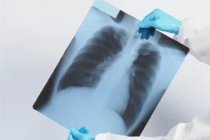 Tamil Nadu launches AI-based model to predict TB death risk at diagnosis