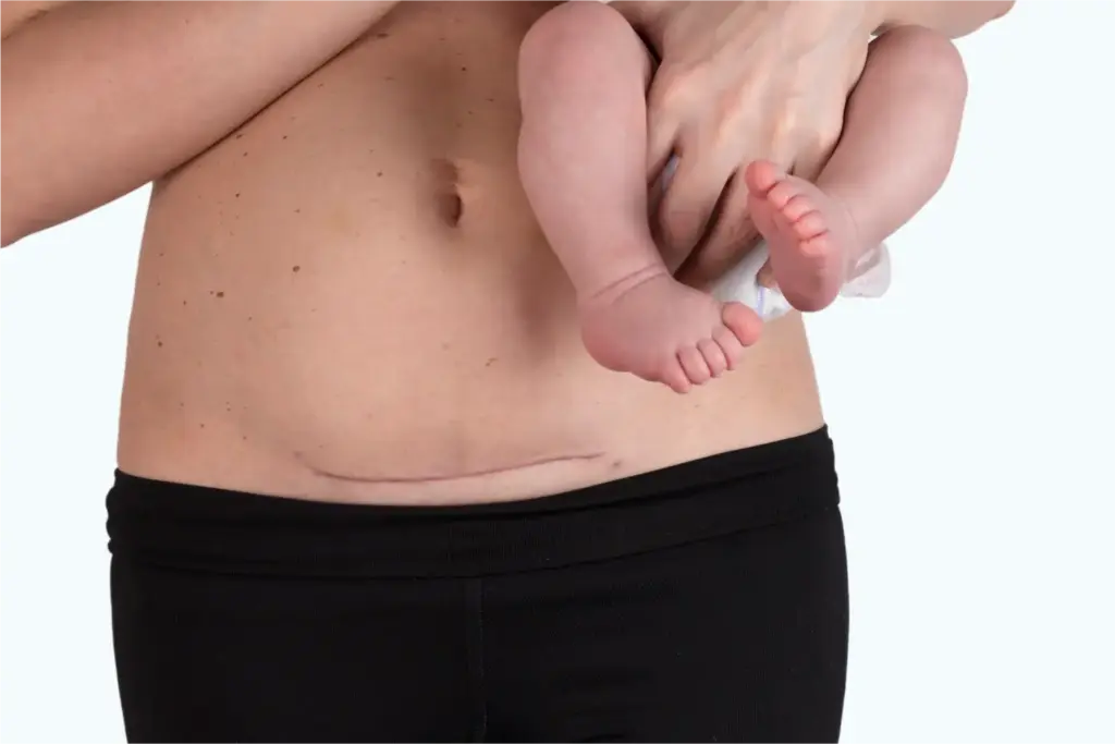C-section rates double across Asia, with India showing steepest rise 1 C-section rates double across Asia, with India showing steepest rise