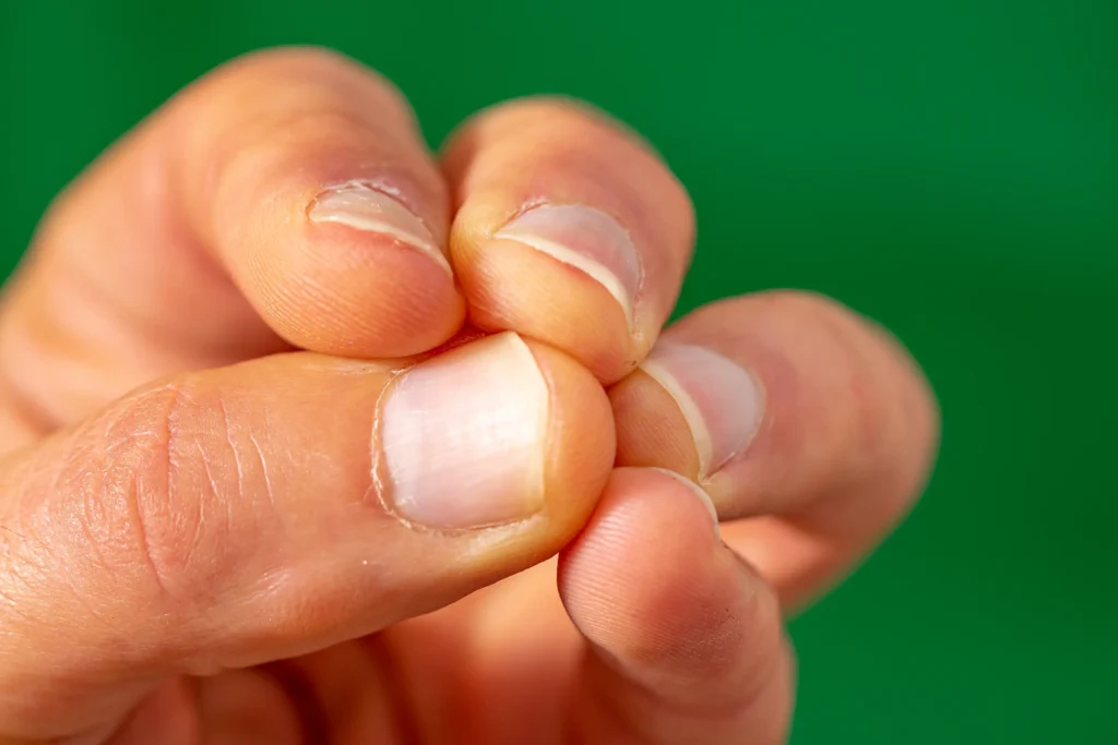 Could brittle nails signal a lack of vitamins or minerals? 1 Could brittle nails signal a lack of vitamins or minerals?
