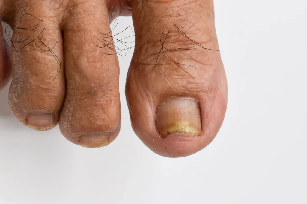 Could brittle nails signal a lack of vitamins or minerals? 2 Could brittle nails signal a lack of vitamins or minerals?