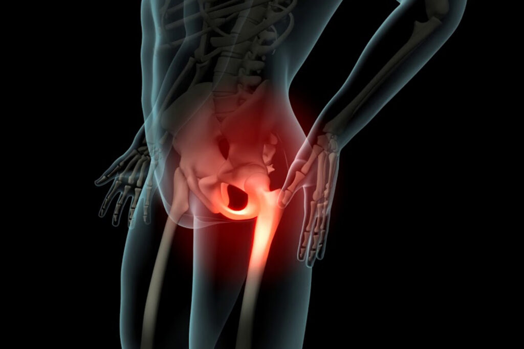 How poor posture and imbalance lead to chronic hip pain
