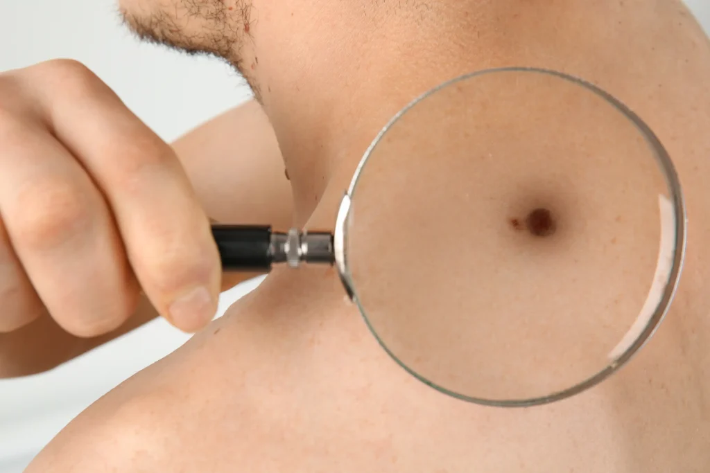 Is that mole dangerous? Skin cancer signs you can’t afford to miss