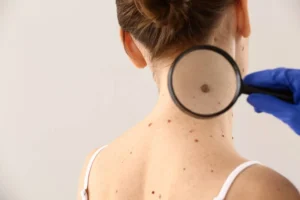 Is that mole dangerous? Skin cancer signs you can’t afford to miss