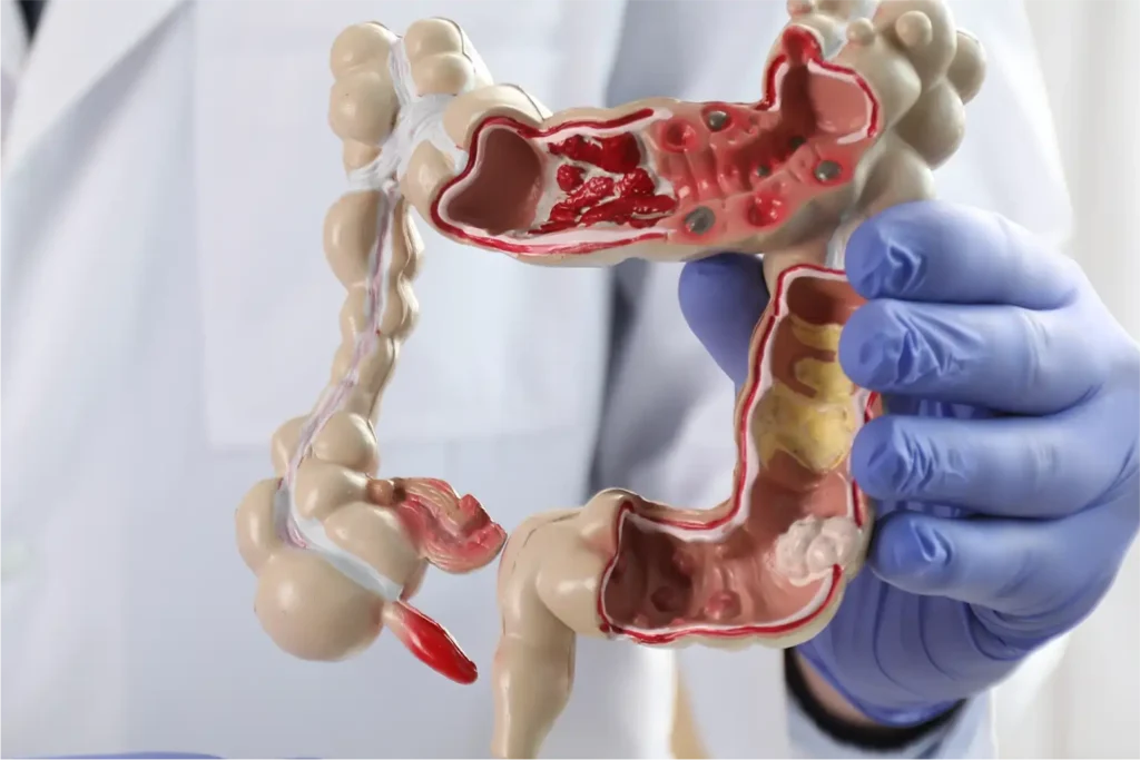 Lowered screening age may be driving surge in colorectal cancer diagnoses: Study 1 Lowered screening age may be driving surge in colorectal cancer diagnoses: Study
