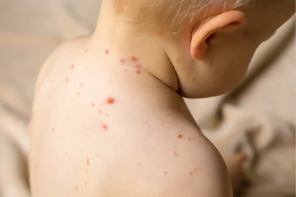 Measles outbreak in Texas officially over after 762 cases 1 Measles outbreak in Texas officially over after 762 cases