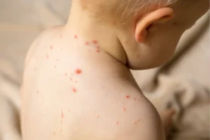 Measles outbreak in Texas officially over after 762 cases