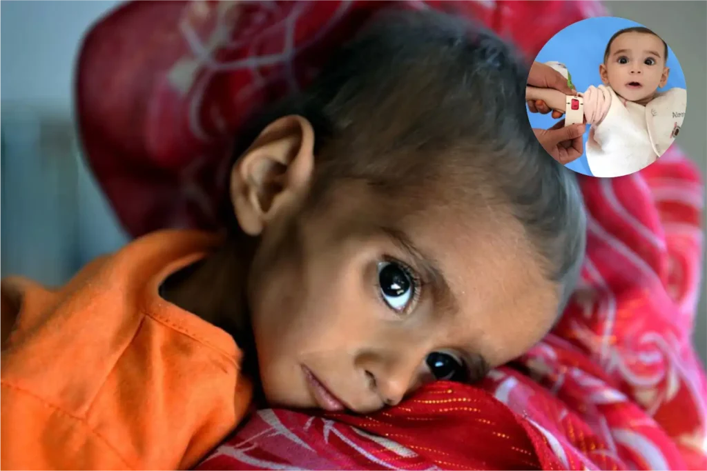 One in three Afghan children stunted amid soaring malnutrition: UN 1 One in three Afghan children stunted amid soaring malnutrition: UN