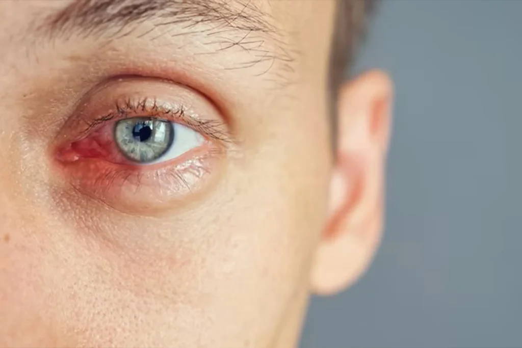 Red, watery eyes? Here’s how to tell if it’s an allergy or infection