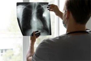 WHO updates TB guidance after Indian study links nutrition to lower risk