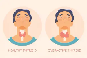 Hyperthyroidism vs. hypothyroidism: Key differences, symptoms & treatment