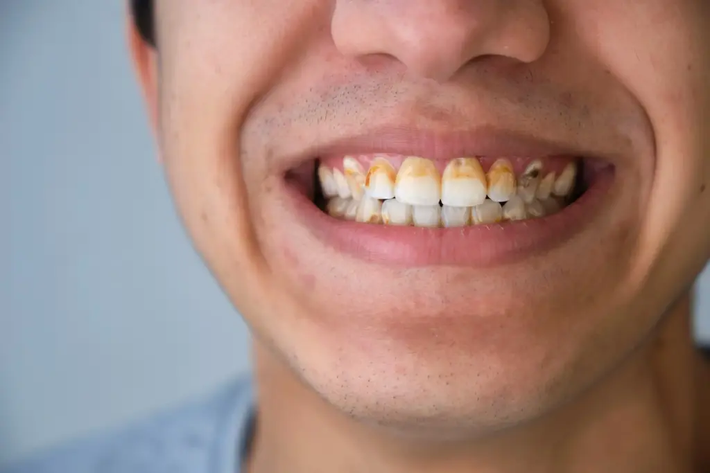 Plaque on teeth: What it is and how to remove it safely 2 Plaque on teeth: What it is and how to remove it safely