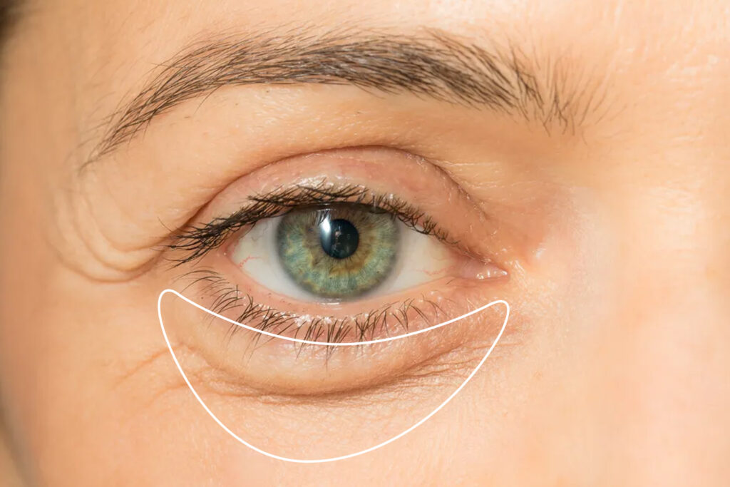 Say goodbye to puffy eyes: Causes and simple solutions 2 Say goodbye to puffy eyes: Causes and simple solutions