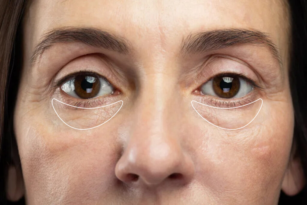 Say goodbye to puffy eyes: Causes and simple solutions 1 Say goodbye to puffy eyes: Causes and simple solutions
