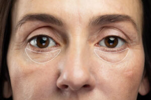 Say goodbye to puffy eyes: Causes and simple solutions