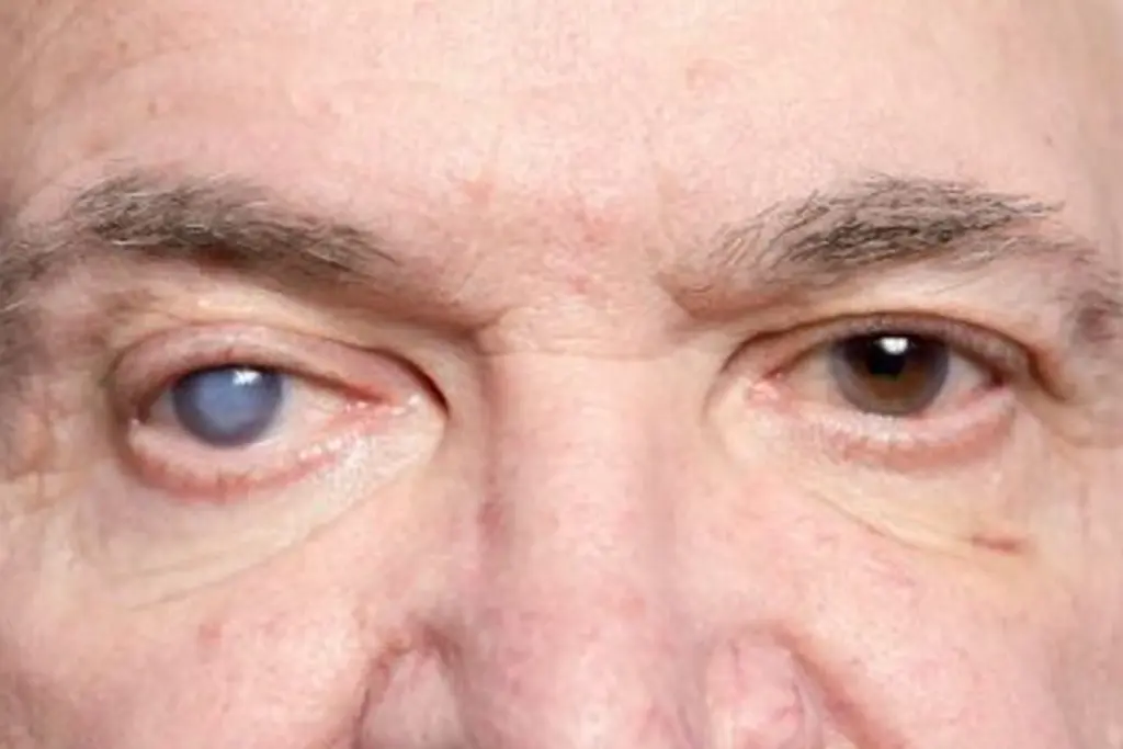 Dealing with cataracts after 40: Symptoms, causes & surgery options 1 Dealing with cataracts after 40: Symptoms, causes & surgery options