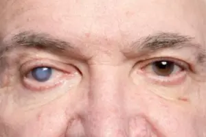 Dealing with cataracts after 40: Symptoms, causes & surgery options