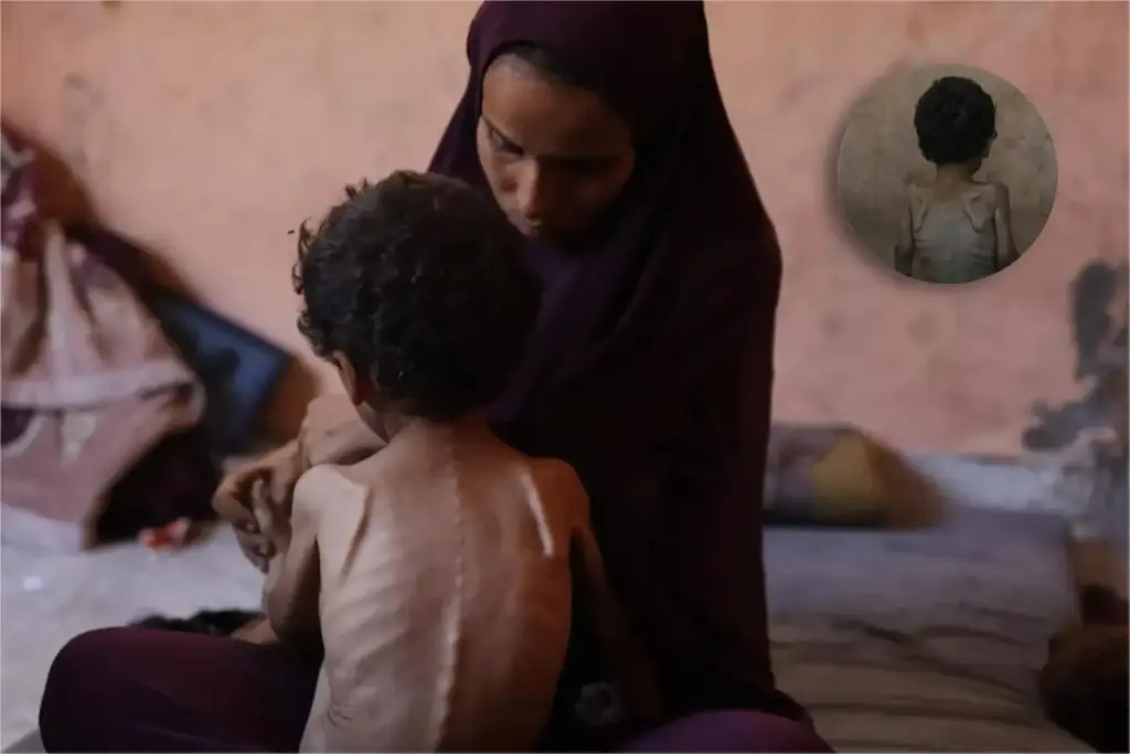 54,600 under-5s acutely malnourished in Gaza, shows UN study
