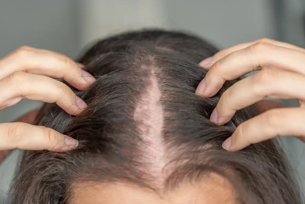 Alopecia areata: What to know about this autoimmune hair loss 2 Alopecia areata: What to know about this autoimmune hair loss