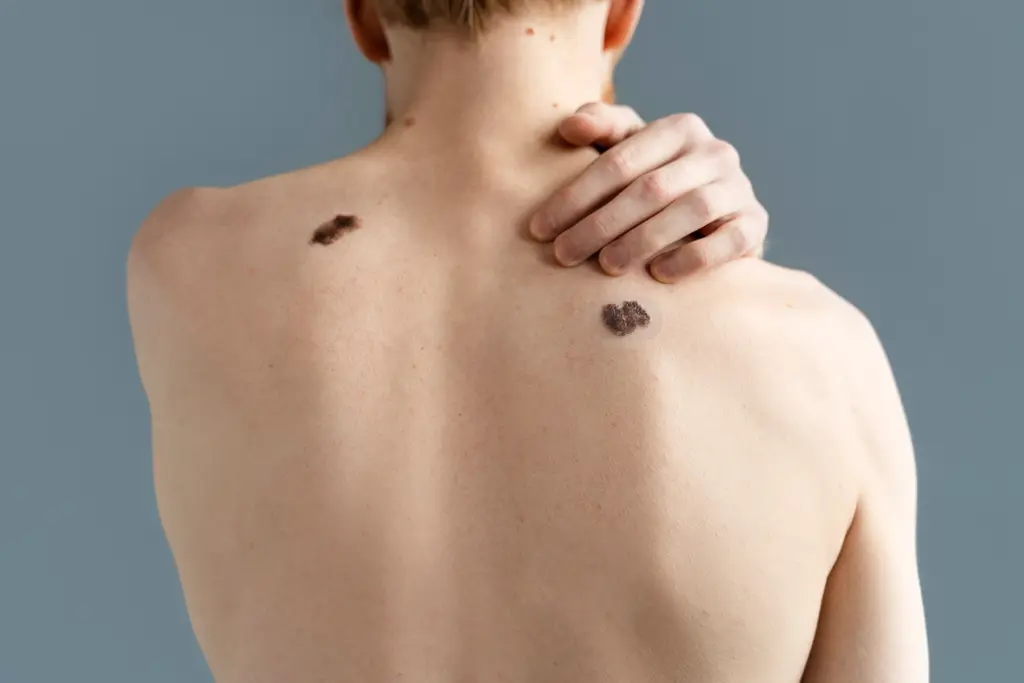 How to spot skin cancer early at home