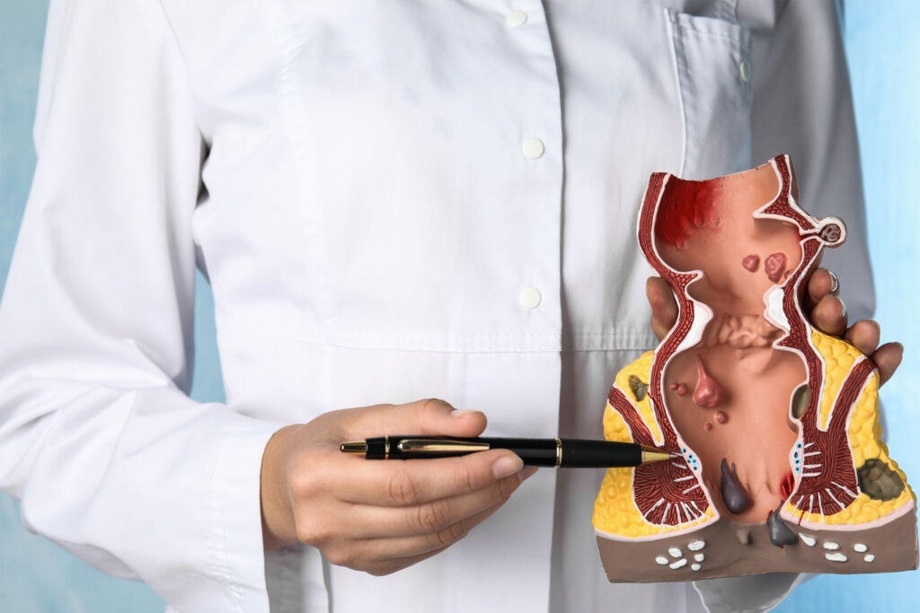 What to expect from non-surgical and surgical piles treatments